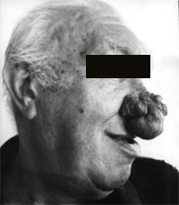демодекоз носа фото до лечения