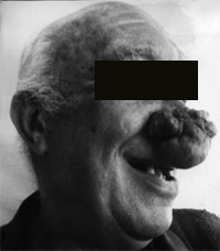 демодекоз носа фотография до лечения 