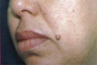 удаление родинок на лице удаление родинок на лице до операции