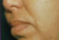 радиоволновое удаление родинок радиоволновое удаление родинок после операции